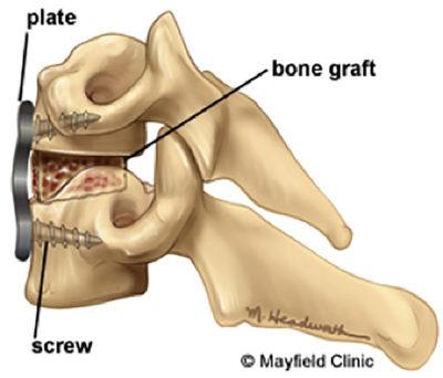 ACDF Spinal Surgery